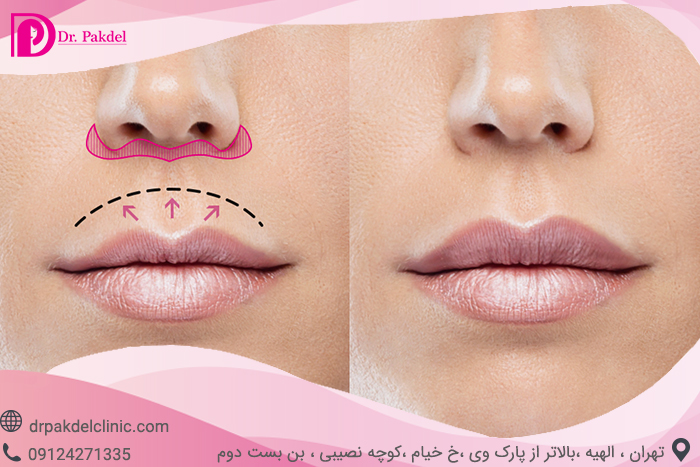 لیفت سانترال لب, جراحی بالا کشیدن لب, Central lip lift