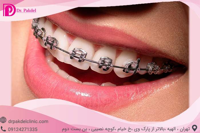 ارتودنسی دندان چیست؟انواع ارتودنسی دندانorthodontics