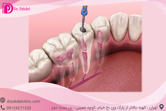 عصب کشی دندان چه زمانی باید انجام شود؟